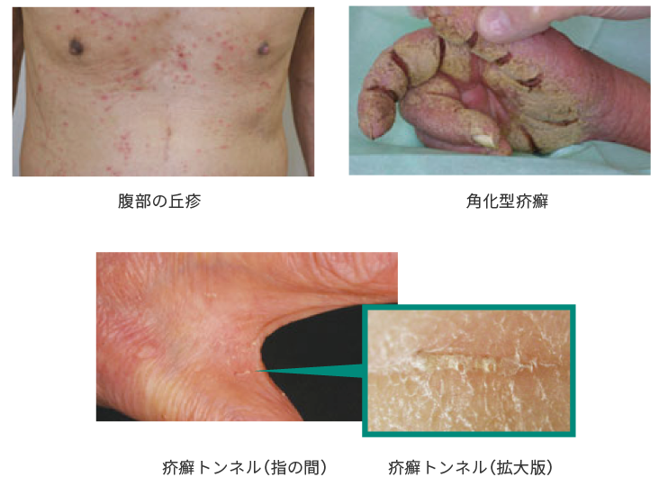 疥癬 かいせん 皮膚科学関連医療薬品のマルホ